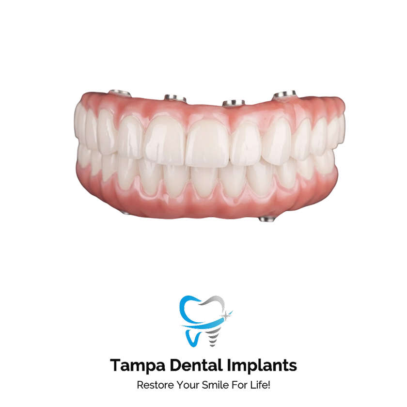 All-On-6 Zirconia